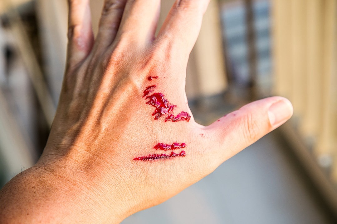 Dog Attack Injury